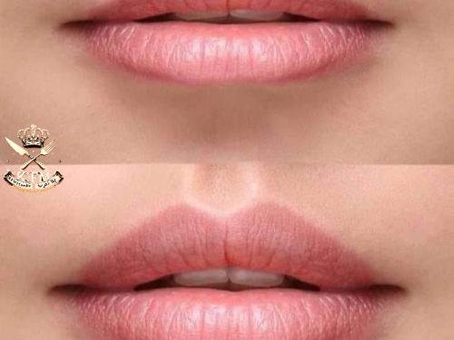 Natural Lip Plumping Treatment